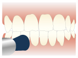 歯を白くする治療