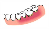 歯石付きの口腔内