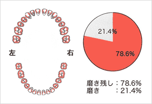 初診時のプラーク状況